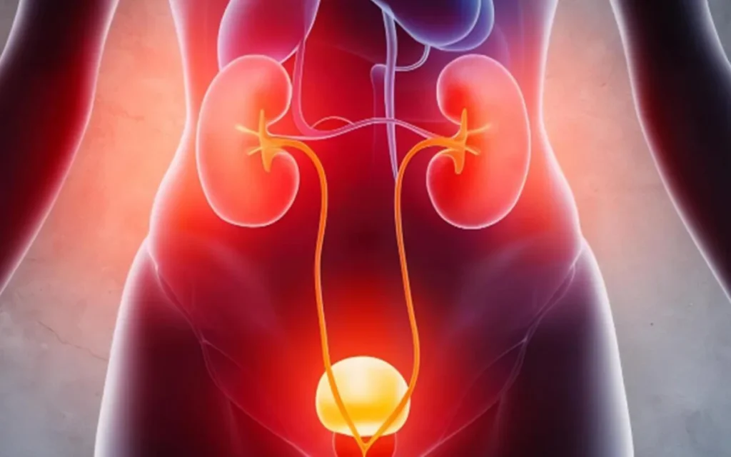 Urinary-Tract-Infection