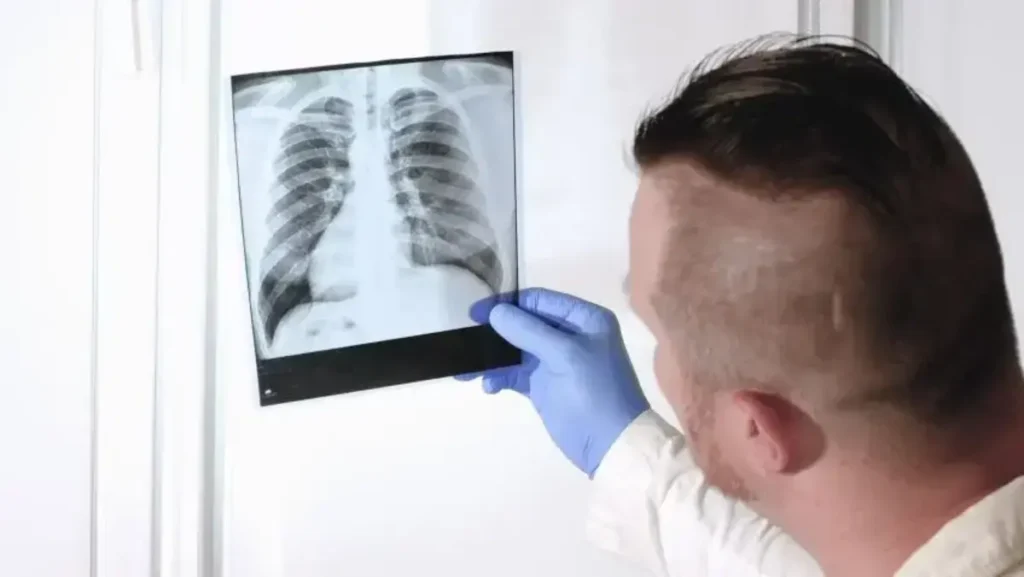 tuberculosis lung vs healthy lung, washington medical clinic