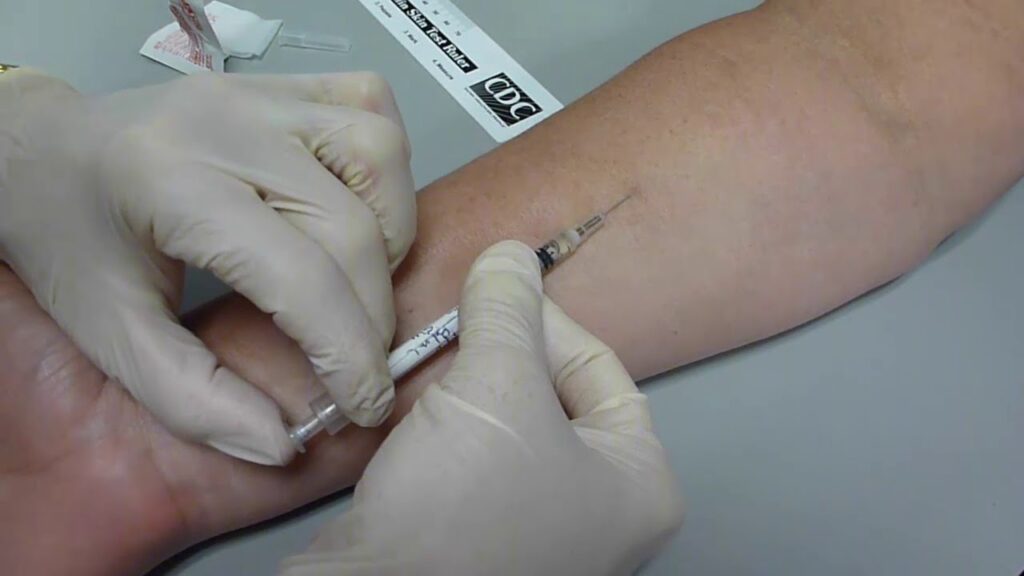 tb skin test